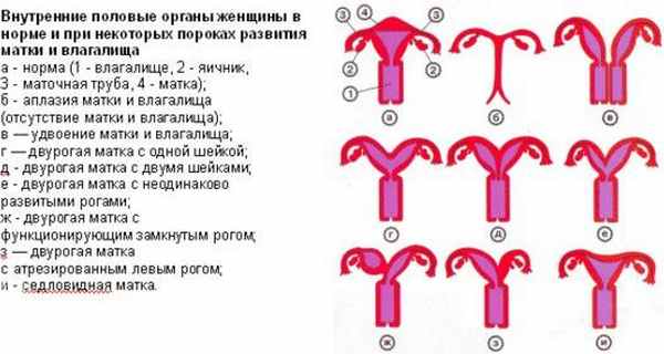 Варианты двурогой матки