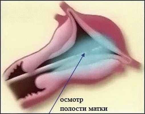 Осмотр полости матки