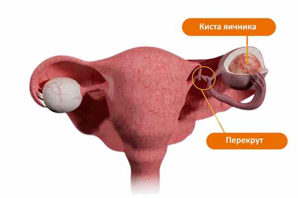 Киста яичника - симптомы и лечение