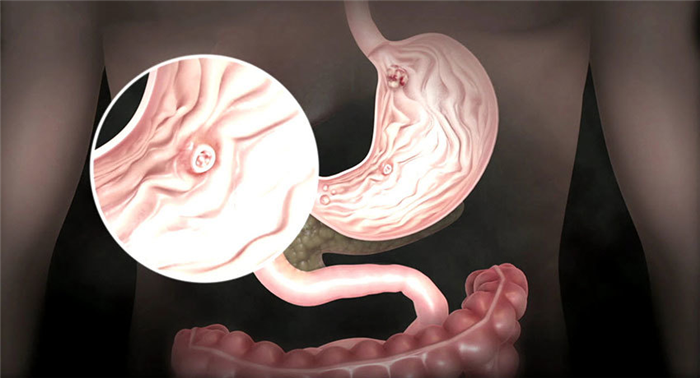 Рак желудка