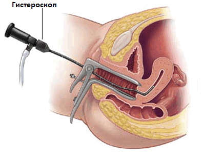 Методика гистреоскопии