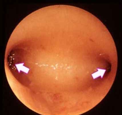 Нормальное изображение полости матки