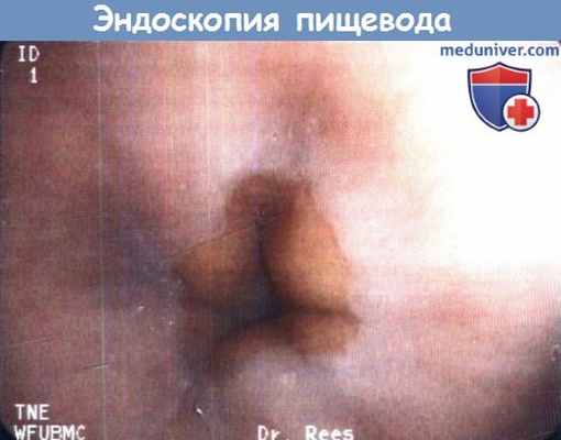 Эндоскопия пищевода