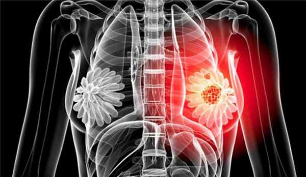 Люминальный рак молочной железы