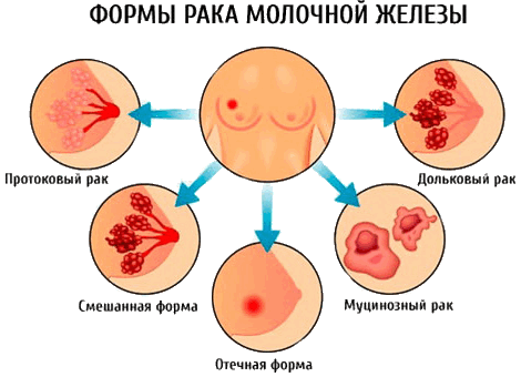Разновидности рака молочной железы