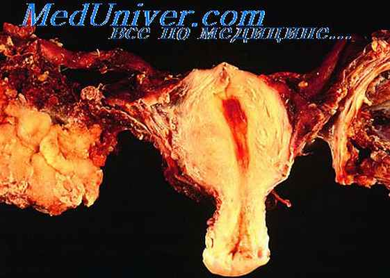 лютеома беременности