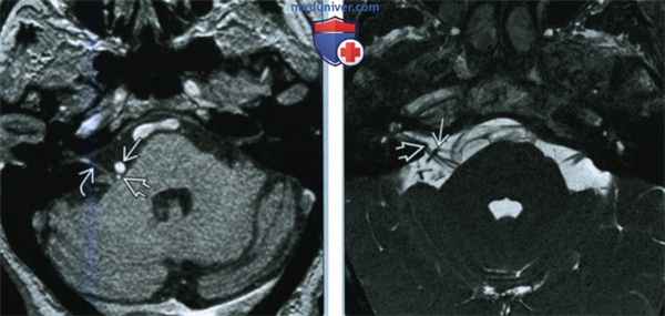 Гемифациальный спазм - лучевая диагностика