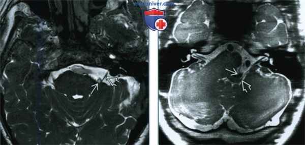 Гемифациальный спазм - лучевая диагностика