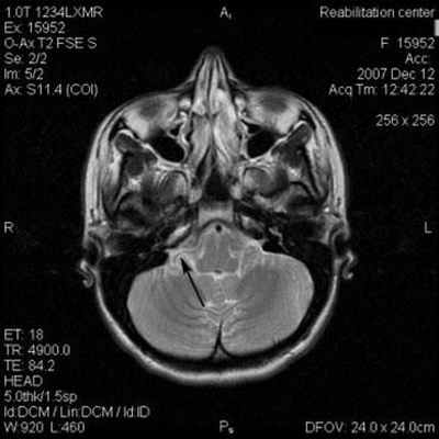  МРТ при нейроваскулярном конфликте