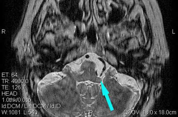  МРТ при нейроваскулярном конфликте