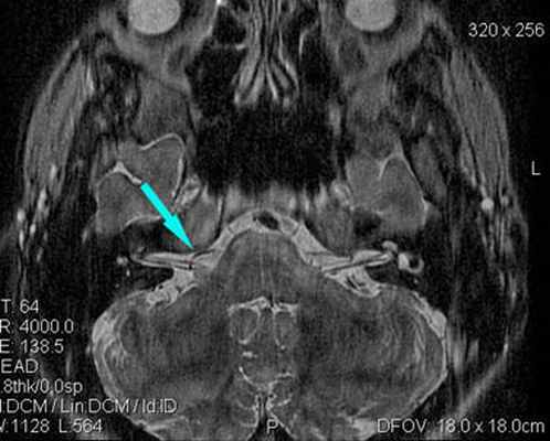 МРТ при нейроваскулярном конфликте