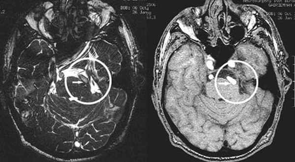  МРТ при нейроваскулярном конфликте