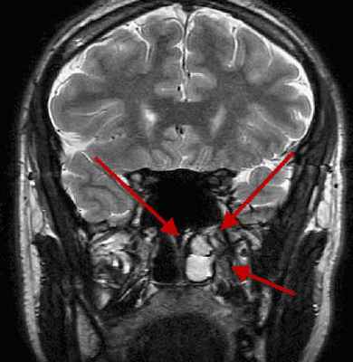 МРТ аденомы гипофиза