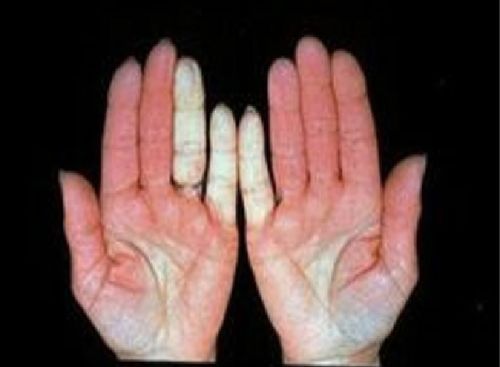 Лечение макроглобулинемии Вальденстрема за рубежом