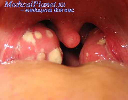 ангина полости рта