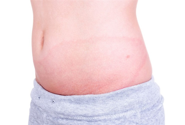 мастоцитоз у детей