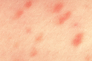 Мастоцитоз