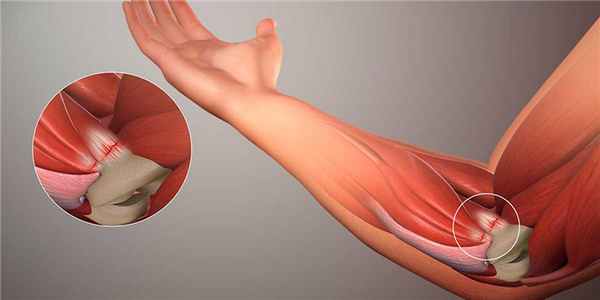 Эпикондилит