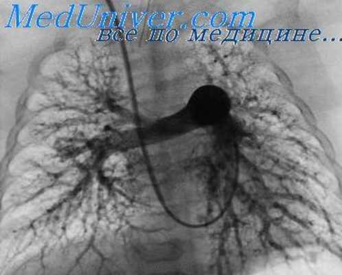 медиастинальная флебография