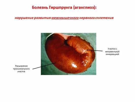 Болезнь Гиршпрунга (аганглиоз): нарушение развития межмышечного нервного сп. 