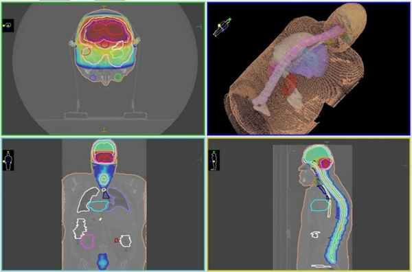 Медуллобластома: лучевое лечение IMRT в Клинике Спиженко в Киеве