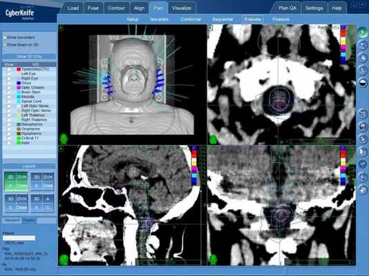 Медуллобластома: лечение на КиберНоже в Клинике Спиженко в Киеве
