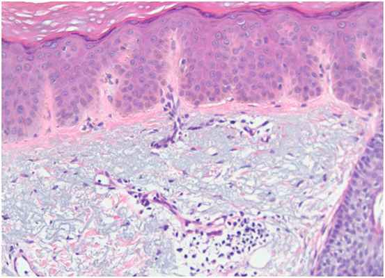 Глубокие пигментации - изменения при лентиго