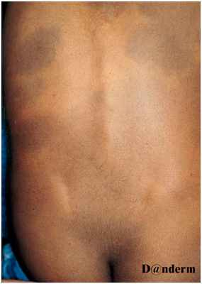 Глубокие пигментации - врожденный дермальный меланоз