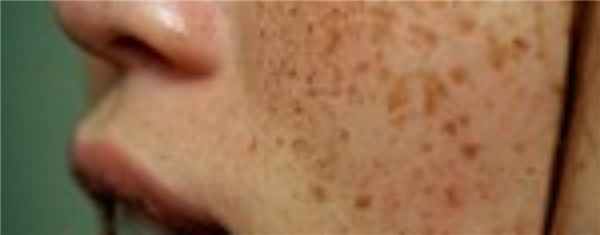 гиперпигментация на теле