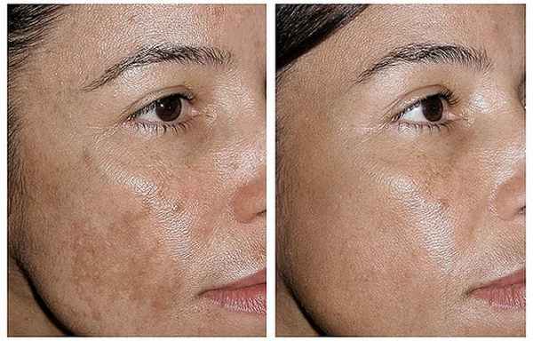 гиперпигментация лица