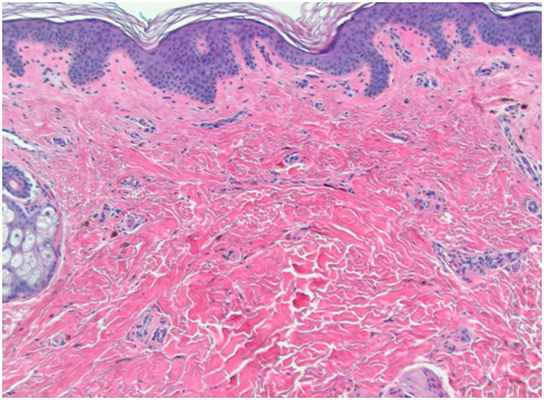 Глубокие пигментации - гистологические изменения