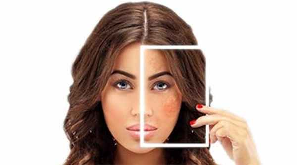 Гиперпигментация кожи