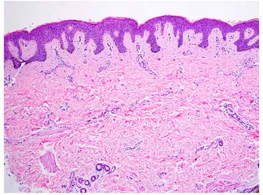 Глубокие пигментации - гистологические изменения в невусе Беккера