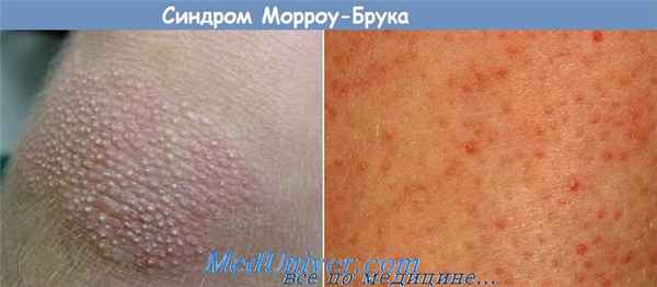 синдром Морроу-Брука