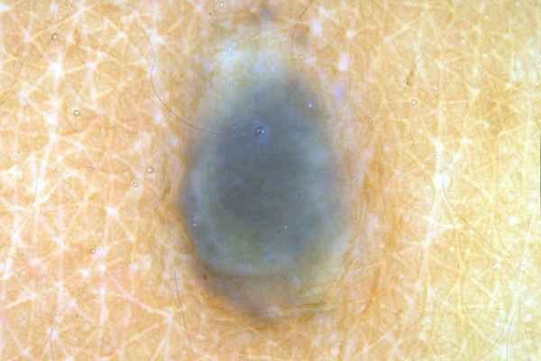 голубой невус фото