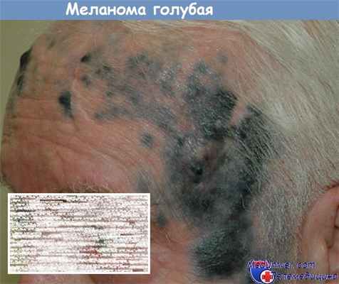 Меланома голубая - невус голубой злокачественный