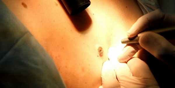 Лазерное удаление новообразований