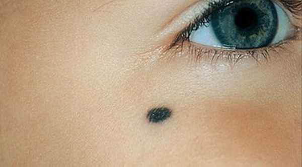 Голубой невус