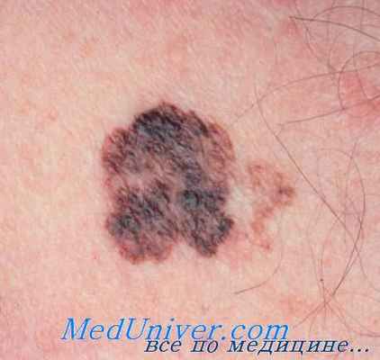 меланома на коже