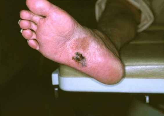 меланома стопы