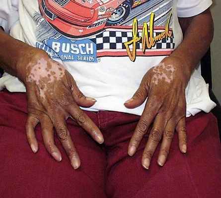 Акрально-лентигинозная меланома