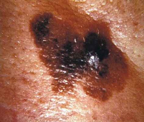 меланома кожи