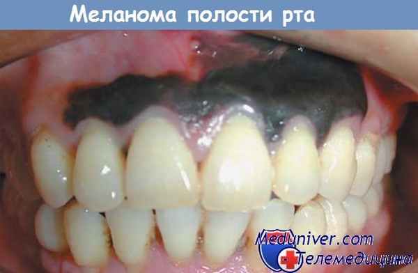 Меланома полости рта