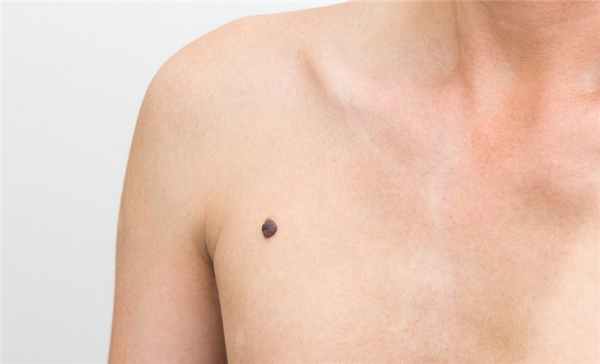 Узловая меланома