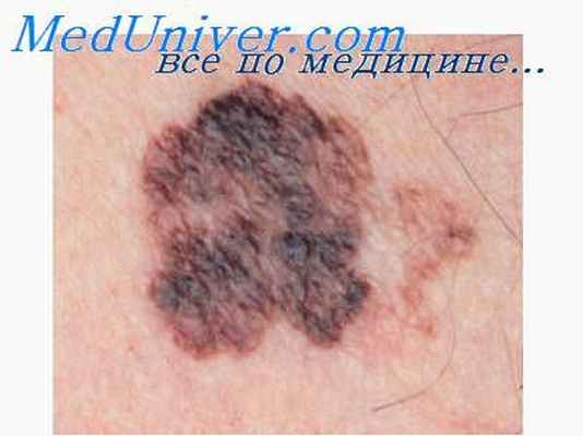 меланоцитарные невусы