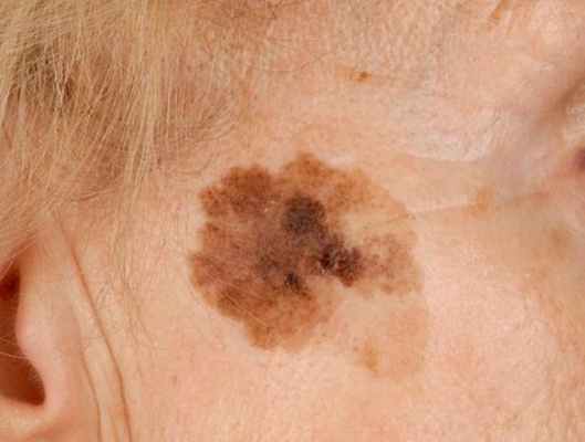 Меланоз Дюбрейля