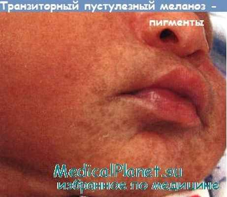 Транзиторный пустулезный меланоз