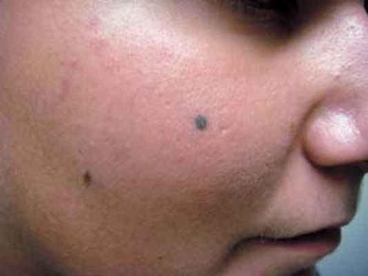 Невусы на лице
