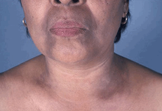 Пятна меланоза