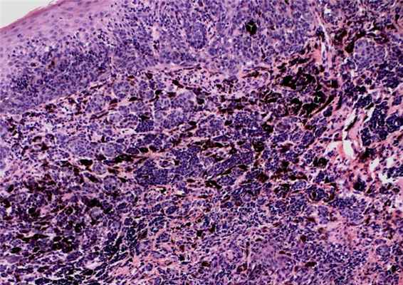 Микроскопия участка кожи с невусом